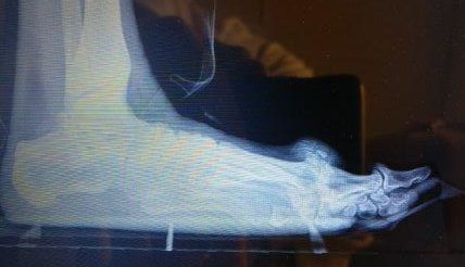 hallux rigidus big toe joint arthritis