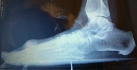 hallux rigidus big toe joint arthritis