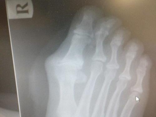 Hallux Rigidus Big Toe Arthritis Podiatrists And Foot Doctors