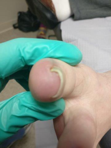 Toe Nail Coming Off the Nail Bed