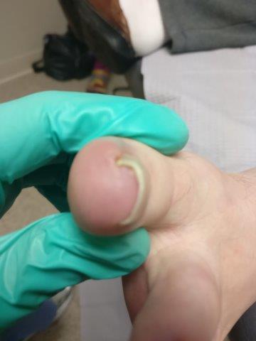 ingrown toenail with pus treatment