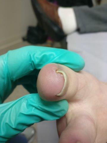 ingrown toenail with pus