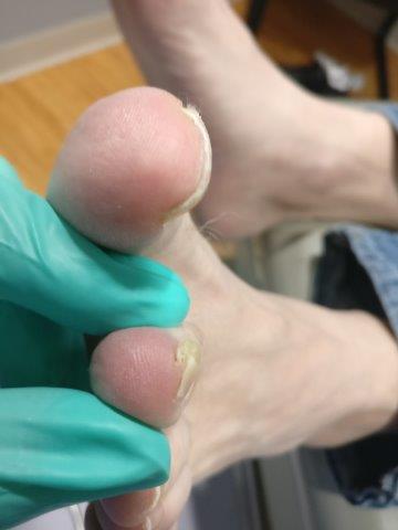 2nd toe ingrown toenail with big toenail joint ingrown toenails