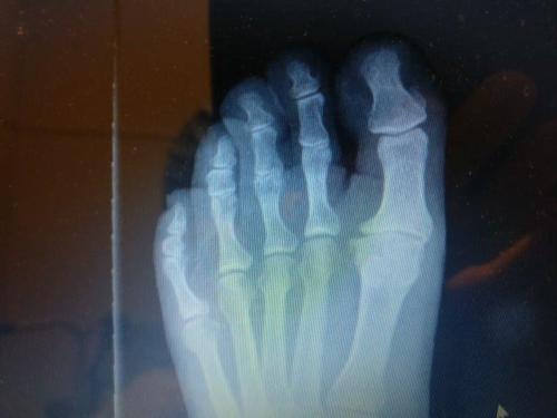 hallux rigidus