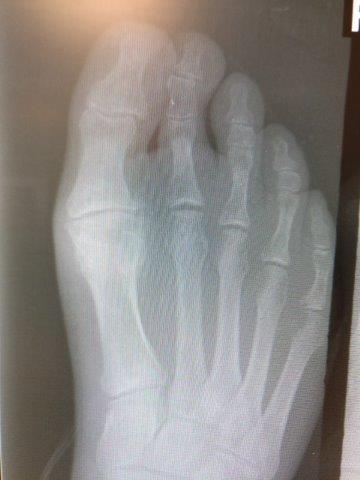 hallux rigidus big toe joint arthritis