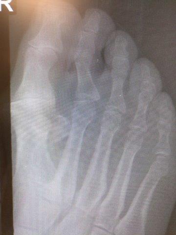 hallux rigidus big toe joint arthritis