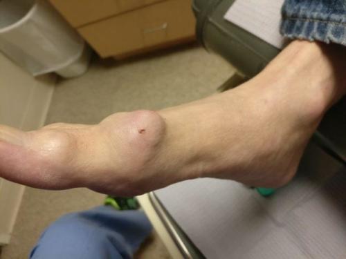 chronic goutaceous tophi in the big toe joint