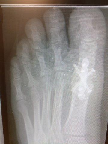 big toe joint fusion1st MTPJ fusion