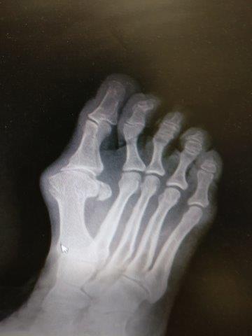 bunion hallux valgus hallux rigidus big toe joint arthritis