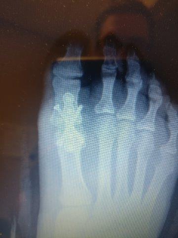 big toe joint MTPJ fusion