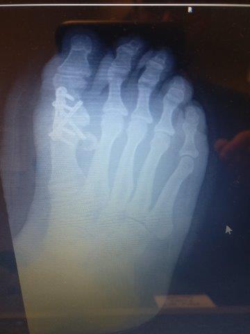 big toe joint MTPJ fusion