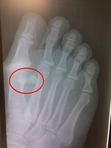 Bipartite sesamoid, fractured sesamoid treatment