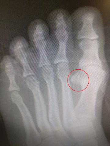 Dislocated sesamoid, sesamoiditis, chronic sesamoiditis