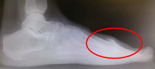 Hallux Rigidus bone spur to the top of the foot spur