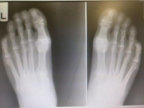 Hallux rigidus big toe joint