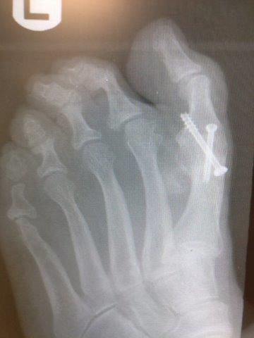 first MTPJ fusion of the big toe joint with screws.