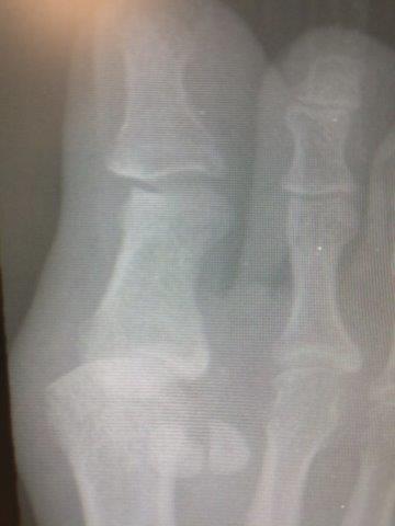 dislocated 1st MTPJ metatarsal phalangeal joint dislocation bunion