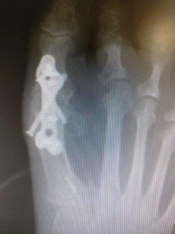 big toe joint fusion with a plate 1st MTPJ fusion