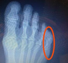 Broken 5th toe vs sprained 5th toe