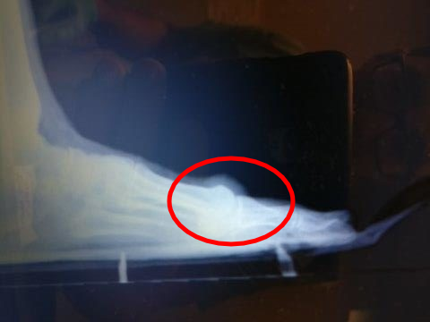 top of the big toe joint bone spur top of the foot