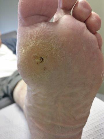 big toe joint ulcer
