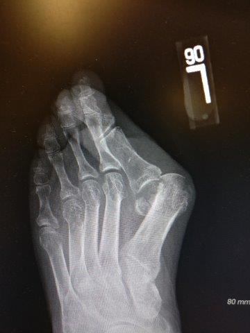 severe bunion hallux valgus