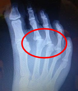 2nd toe predislocation syndrome and 2nd toe dislocation plantar plate rupture