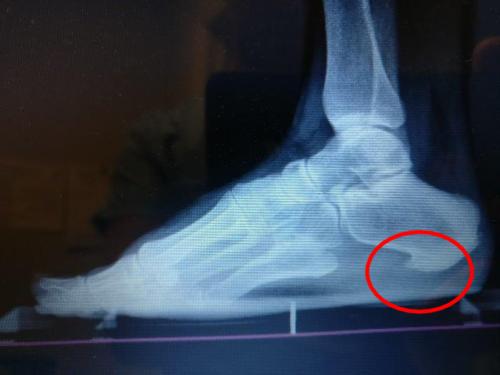 Calcaneus Bone Spur Bottom of the heel spur