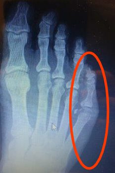 Sprained little toe or broken little toe