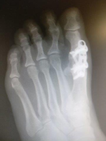 great toe joint fusion recovery time great toe joint