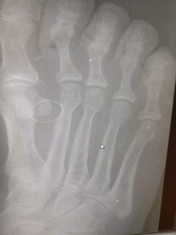 sesamoid dislocation and bunion of the big toe joint