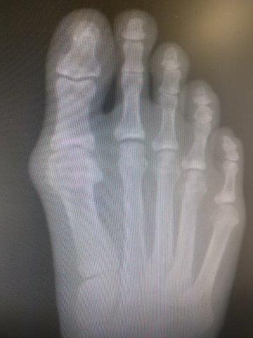 big toe joint arthritis of the big toe joint great toe