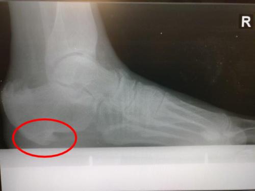 Heel fat pad cushion atrophy and heel spur formation