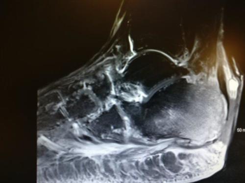 osteomyelitis of the heel with open wound achilles rupture