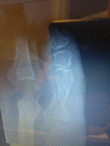 Sprained Pinky Toe Pain or Broken Pinky Toe? 