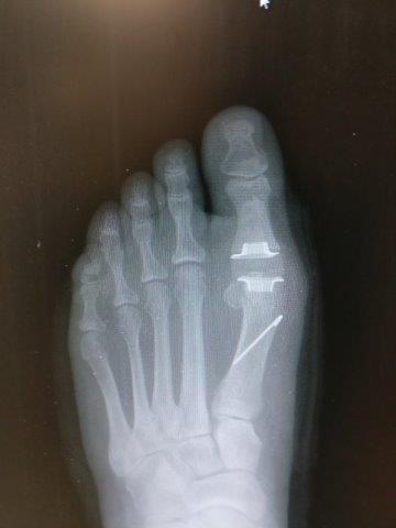 Joint Replacement of the big toe joint recovery time