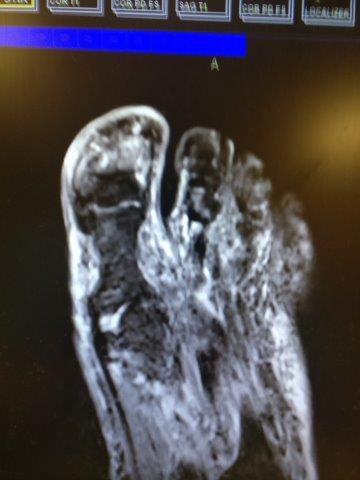 MRI of ingrown toenail and bone infection of the big toe joint