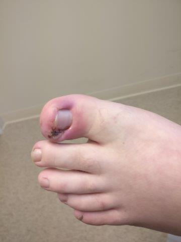 Ingrown Toenail