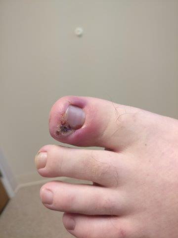 Ingrown Toenail with pus