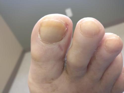 Ingrown toenail between the inner big toe and 2nd toe.