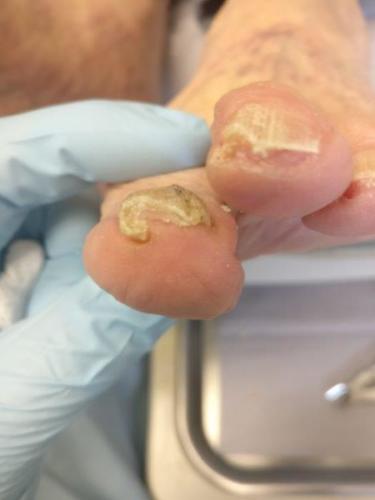 Curved Toenail Treatment