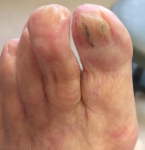 Red Spot Under Toenail