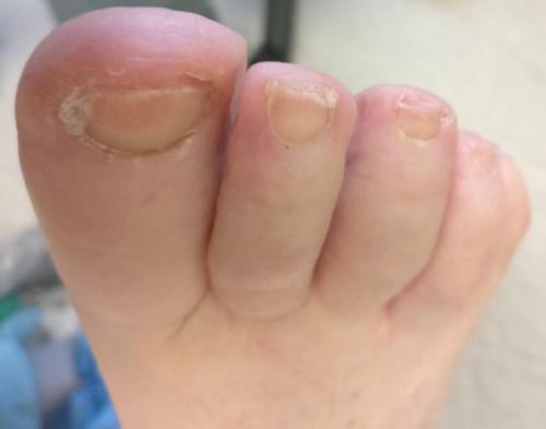 Podiatrist medicare pedicure for toenail fungus