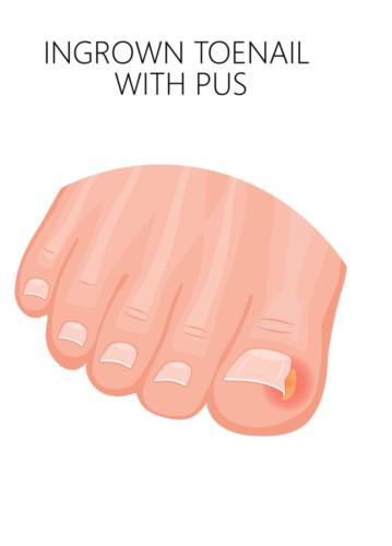 Ingrown toenail with pus