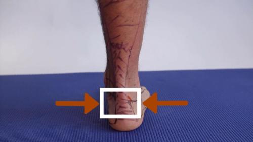 Insertional heel pain achilles tendon