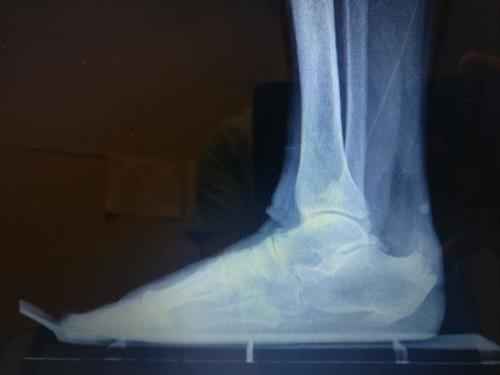 Large posterior heel spur