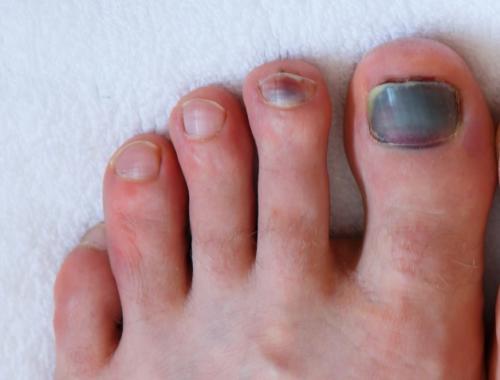 Human male foots with bruised black on toe nails on white background .