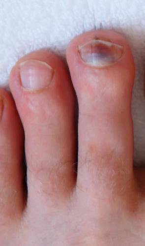 Human male foots with bruised black on toe nails on white background .