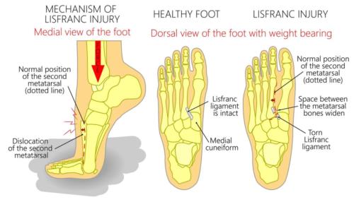 Lisfranc Fracture top of the foot pain