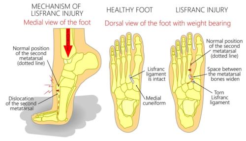 Lisfranc Fracture top of the foot pain